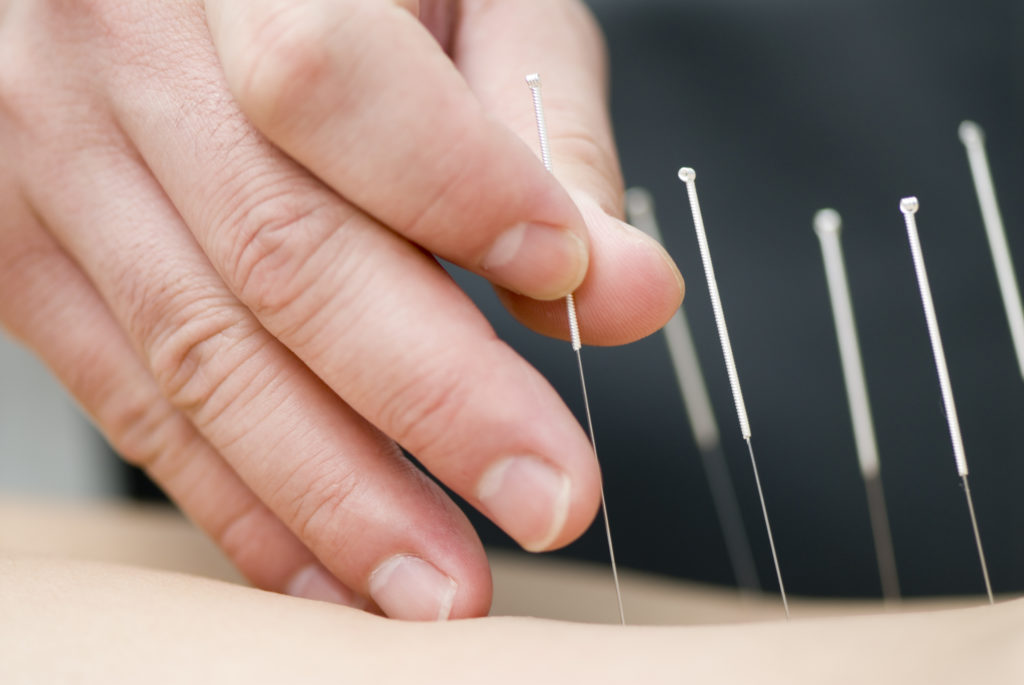 insertion of dry needles for alternative treatment